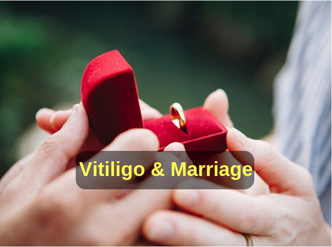 Vitiligo Matrimony Solution To Vitiligo Marriage Problems 7653